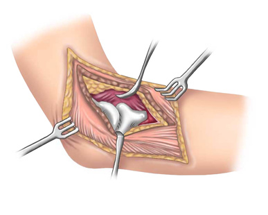 Bursitis